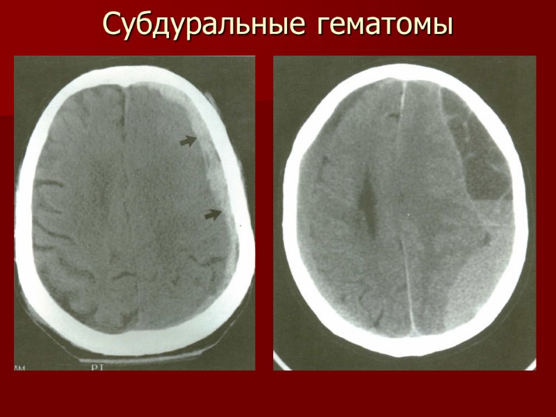 Субдуральные гематомы